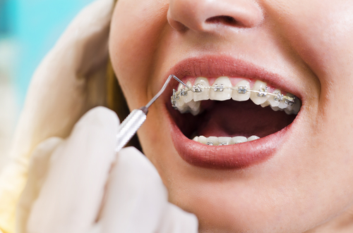 自力で治すのはng 気になる歯並びは矯正治療で改善 Hanone ハノネ 毎日キレイ 歯の本音メディア
