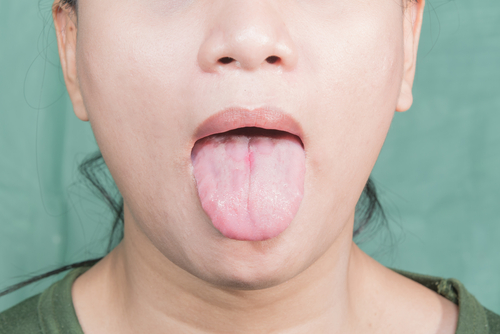 舌にブツブツができたときに考えられる病気は Hanone ハノネ 毎日キレイ 歯の本音メディア