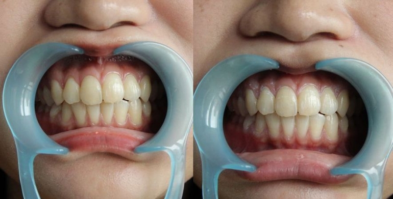 セルフホワイトニング 美歯口 を初体験 歯のケアはサロンやジムで行う時代に Hanone ハノネ 毎日キレイ 歯の本音メディア