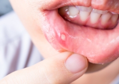 痛い パイナップル 唇 口腔アレルギー症候群とは？治療と対策 [アレルギー]