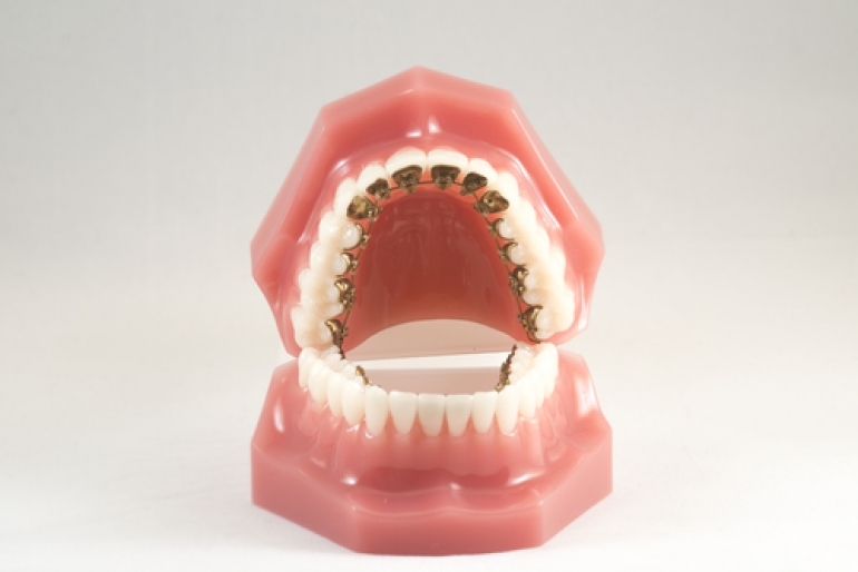 歯列模型正面