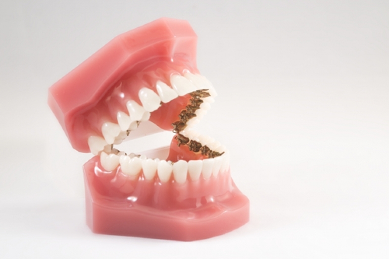歯列模型横