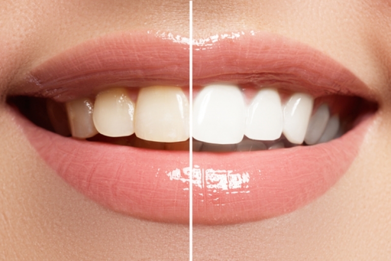 歯の裏側が茶色い 汚れてしまう原因や白くする方法 Hanone ハノネ 毎日キレイ 歯の本音メディア