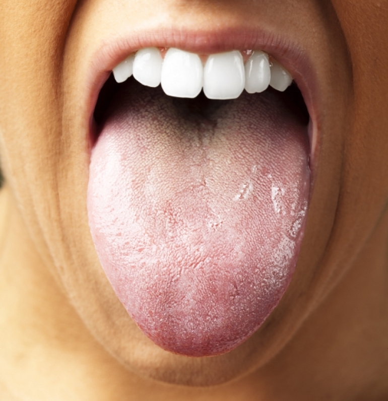 舌の汚れ