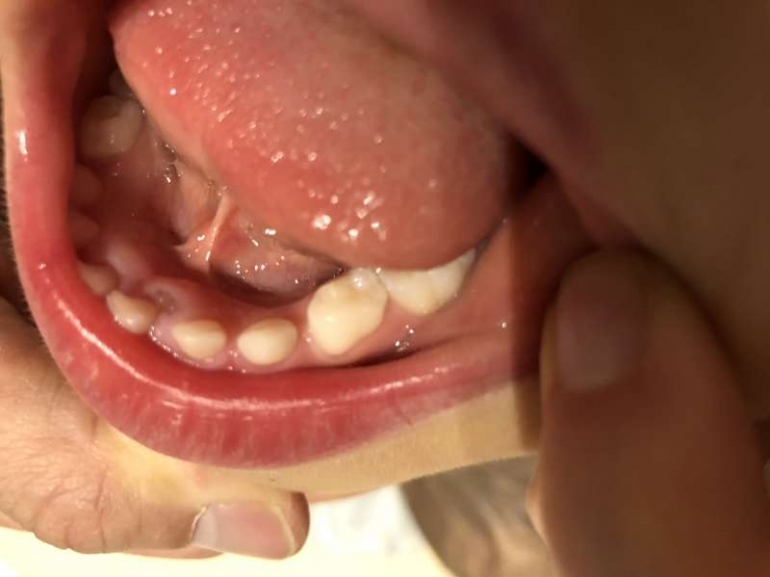 乳歯の裏から永久歯