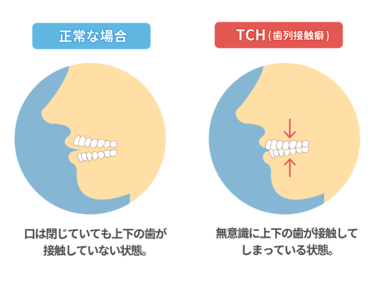 TCHの図解